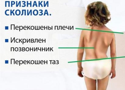 Искривление позвоночника у детей Искривление позвоночника у грудничка как определить