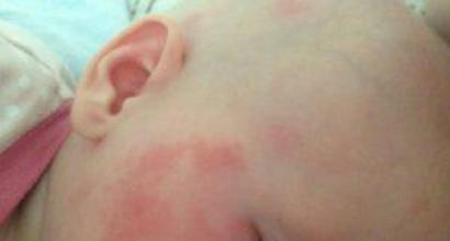Причины возникновения аллергической сыпи у детей: фото высыпаний, характерные особенности и эффективные методы лечения