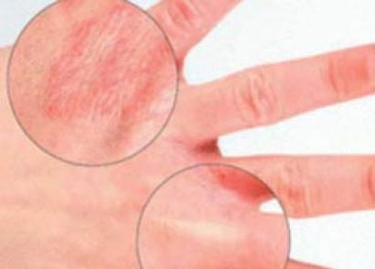 손의 붉은 피부는 무엇을 의미합니까?